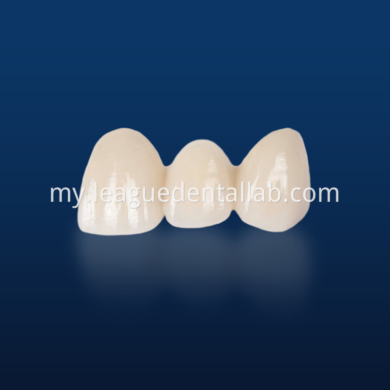 PFM,Metal crown,Fixed metal crown